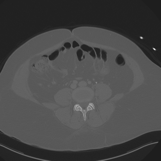 Anterior superior iliac spine avulsion fracture (Radiopaedia 44541-48244 Axial bone window 64).png