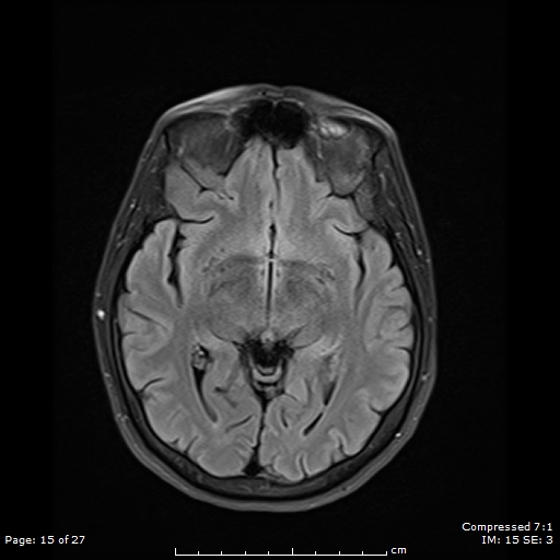 File:Anterior temporal lobe perivascular space (Radiopaedia 88283-104914 Axial FLAIR 15).jpg