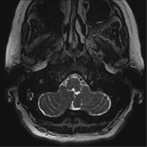 Anterior temporal pole cysts (Radiopaedia 46629-51102 Axial T2 5).png