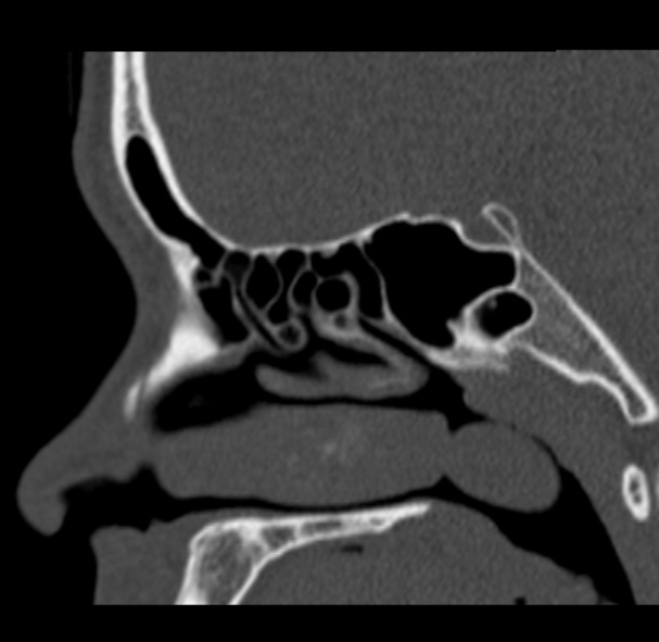 Antrochoanal polyp (Radiopaedia 33984-35202 Sagittal bone window 47).jpg