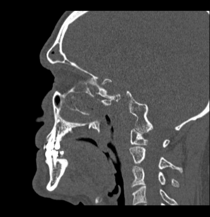 Antrochoanal polyp (Radiopaedia 79011-92169 Sagittal bone window 15).jpg