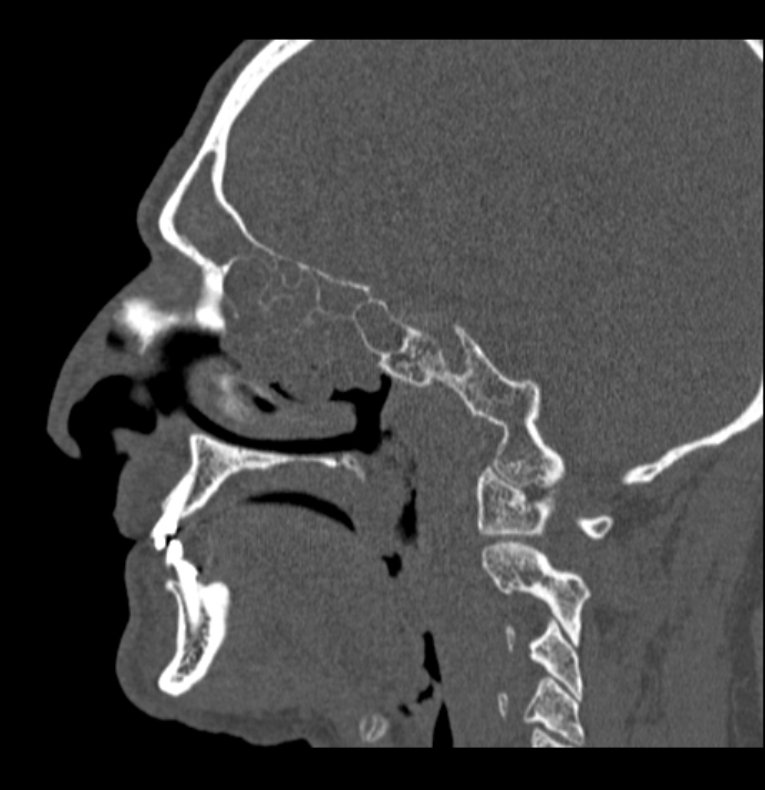 Antrochoanal polyp (Radiopaedia 79011-92169 Sagittal bone window 42).jpg