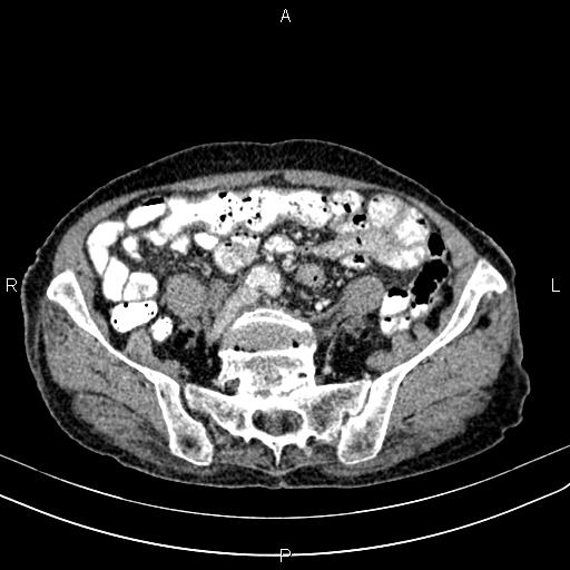 Aortic aneurysm and Lemmel syndrome (Radiopaedia 86499-102554 A 57).jpg