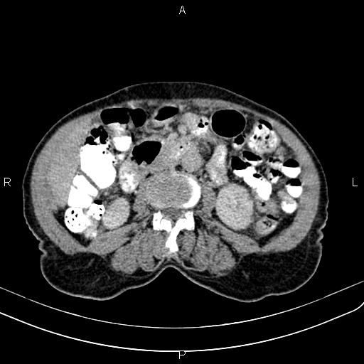 Aortic aneurysm and Lemmel syndrome (Radiopaedia 86499-102554 Axial C+ delayed 39).jpg