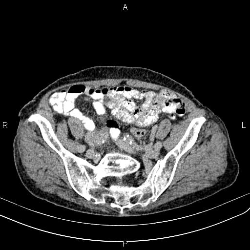 Aortic aneurysm and Lemmel syndrome (Radiopaedia 86499-102554 Axial C+ delayed 61).jpg