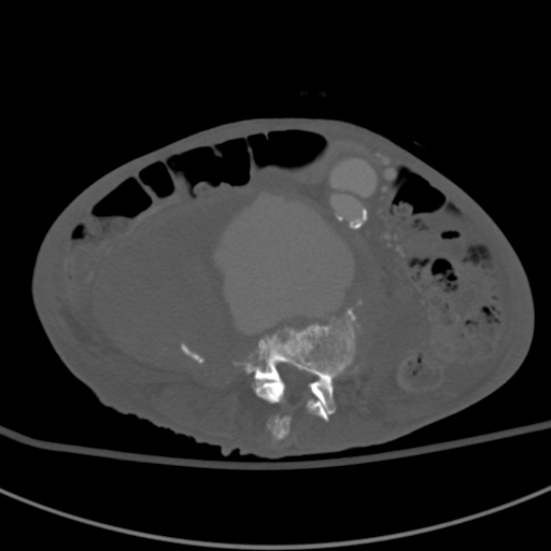 Aortic aneurysm with spinal destruction (Radiopaedia 42301-45410 Axial bone window 60).jpg