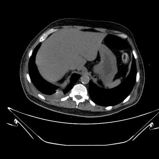 Aortic arch aneurysm (Radiopaedia 84109-99365 Axial non-contrast 257).jpg