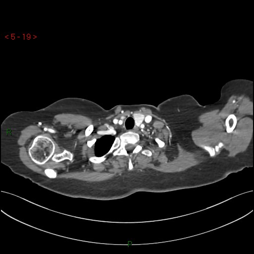 Aortic arch origin of left vertebral artery (Radiopaedia 51520-57286 A 18).jpg