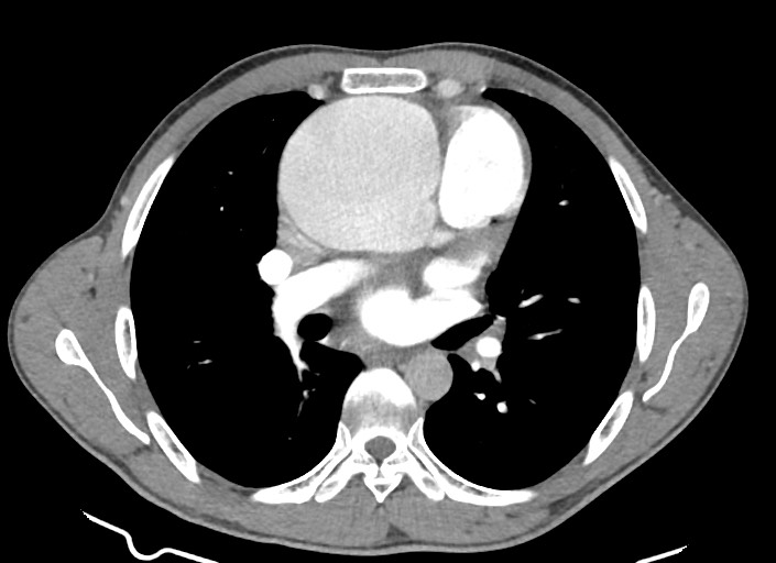File:Aortic coarctation with aneurysm (Radiopaedia 74818-85828 A 116).jpg