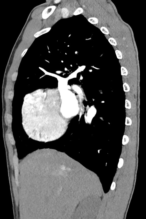 Aortic coarctation with aneurysm (Radiopaedia 74818-85828 B 55).jpg