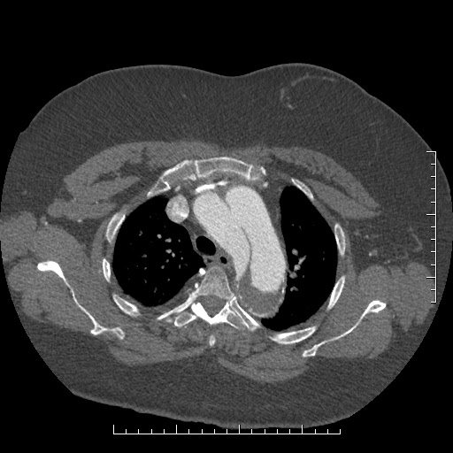 Aortic dissection- Stanford A (Radiopaedia 35729-37268 A 17).jpg
