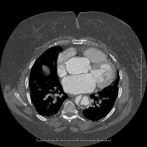 File:Aortic dissection- Stanford A (Radiopaedia 35729-37268 A 56).jpg