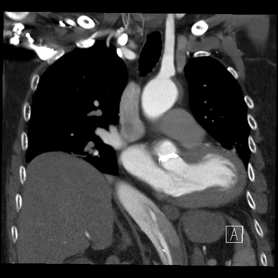 Aortic dissection (CTPA) (Radiopaedia 75506-86750 B 32).jpg