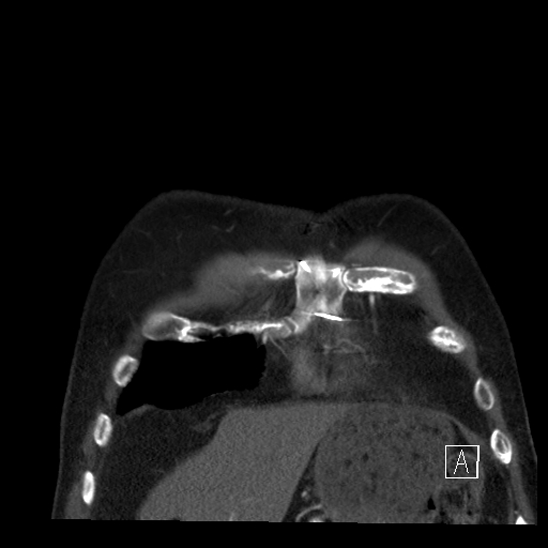 File:Aortic dissection (CTPA) (Radiopaedia 75506-86750 B 7).jpg
