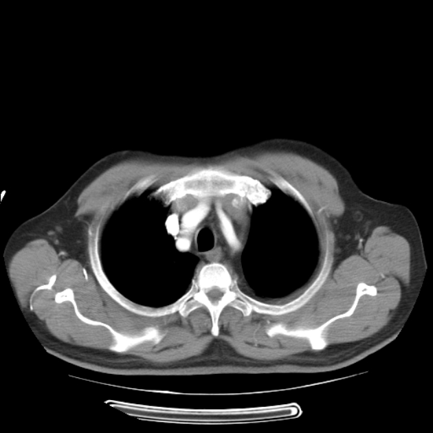 Aortic dissection (Radiopaedia 44411-48061 C 5).jpg