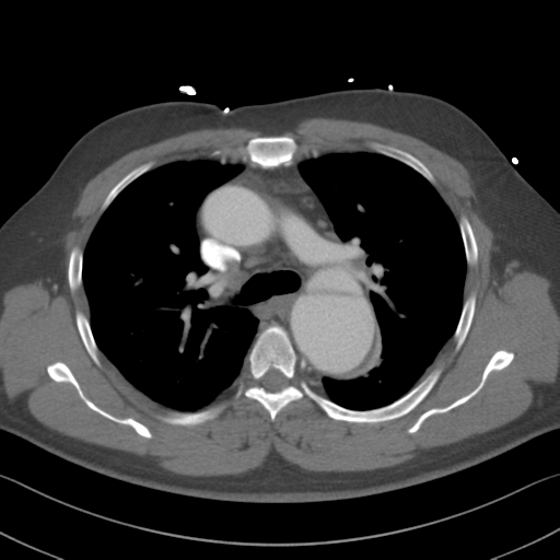 Aortic dissection (Radiopaedia 50763-56234 A 21).png