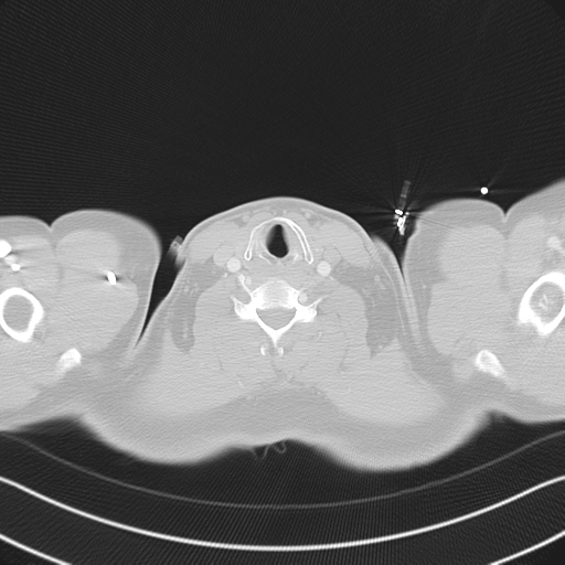 File:Aortic dissection (Radiopaedia 50763-56234 Axial lung window 1).png