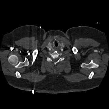 Aortic dissection (Radiopaedia 57969-64959 A 1).jpg