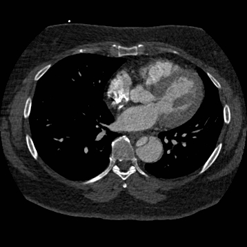 Aortic dissection (Radiopaedia 57969-64959 A 189).jpg