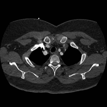 File:Aortic dissection (Radiopaedia 57969-64959 A 54).jpg