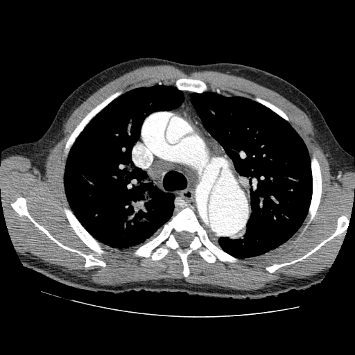 File:Aortic dissection - Stanford A -DeBakey I (Radiopaedia 28339-28587 B 21).jpg