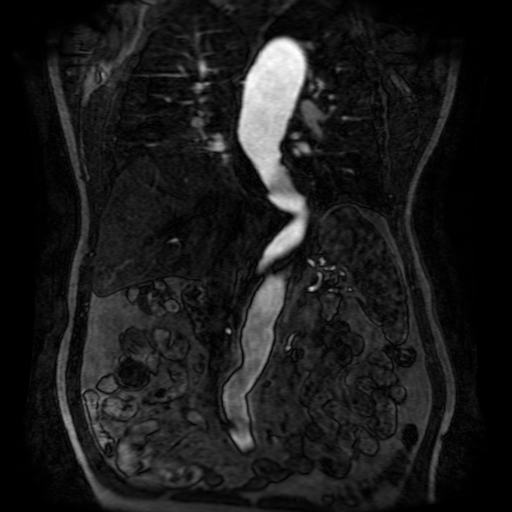 File:Aortic dissection - Stanford A - DeBakey I (Radiopaedia 23469-23551 D 133).jpg