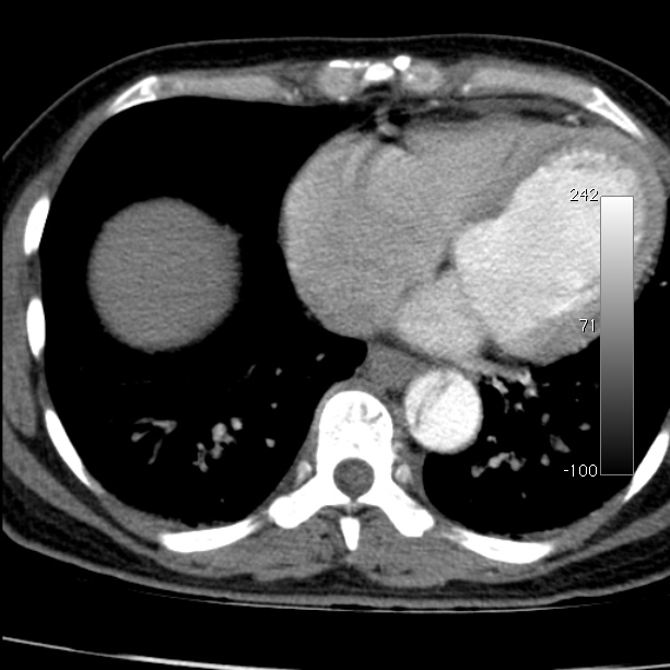 Aortic dissection - Stanford type A (Radiopaedia 29247-29659 A 55).jpg