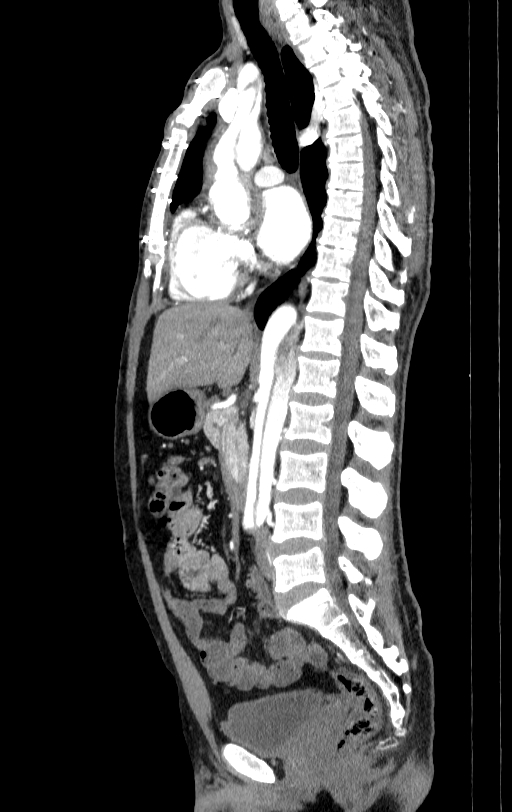 Aortic dissection - Stanford type A (Radiopaedia 83418-98500 B 31).jpg