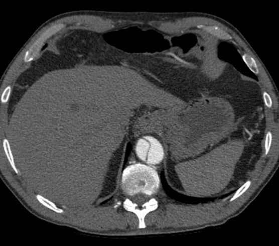 Aortic dissection - Stanford type B (Radiopaedia 73648-84437 A 103).jpg