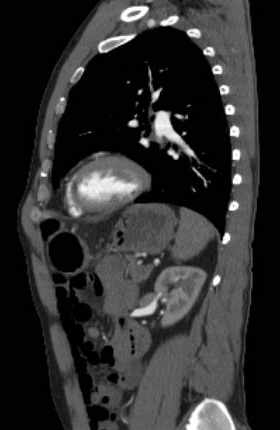 File:Aortic dissection - Stanford type B (Radiopaedia 73648-84437 C 48).jpg