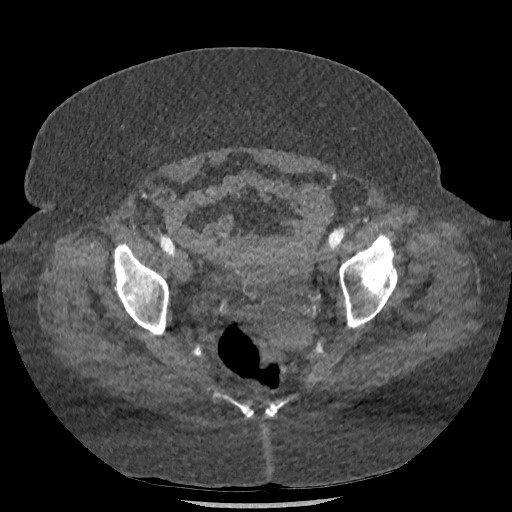 Aortic dissection - Stanford type B (Radiopaedia 88281-104910 A 152).jpg