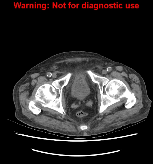 File:Aortic graft infection (Radiopaedia 44979-48907 Axial non-contrast 89).jpg