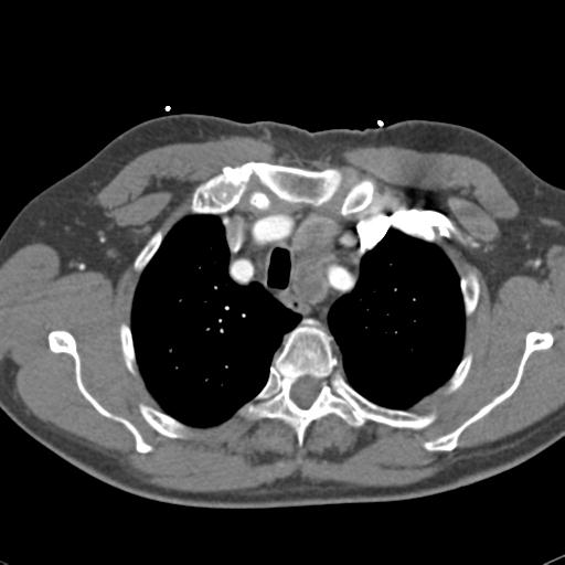 Aortic intramural hematoma (Radiopaedia 31139-31838 B 18).jpg