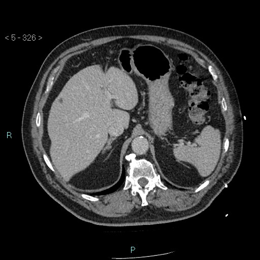 Aortic intramural hematoma (Radiopaedia 48463-53380 C 146).jpg