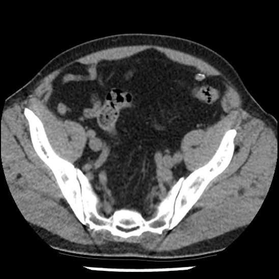 Aortic intramural hematoma (type B) (Radiopaedia 79323-92387 Axial non-contrast 98).jpg