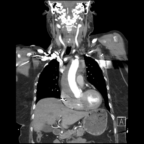 Aortic intramural hematoma with dissection and intramural blood pool (Radiopaedia 77373-89491 C 22).jpg