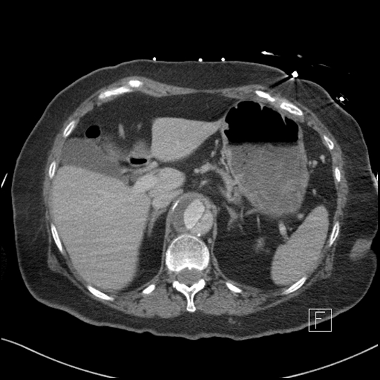 Aortic intramural hematoma with dissection and intramural blood pool (Radiopaedia 77373-89491 E 10).jpg