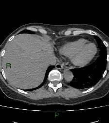 File:Aortic valve endocarditis (Radiopaedia 87209-103485 Axial non-contrast 81).jpg