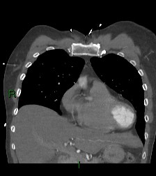 Aortic valve endocarditis (Radiopaedia 87209-103485 D 51).jpg