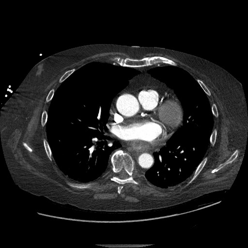 File:Aortoesophageal fistula with endovascular repair (Radiopaedia 73781-84592 Axial C+ CTPA 86).jpg