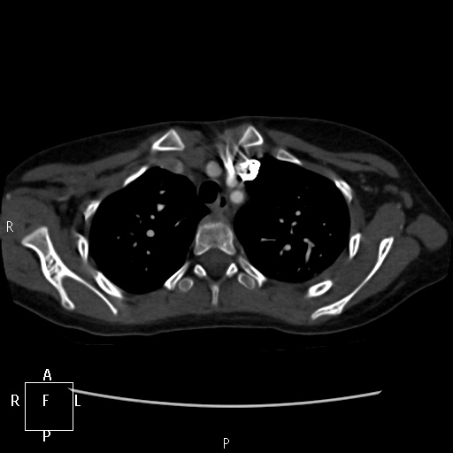 File:Aortopulmonary septal defect (Radiopaedia 41990-45013 Axial C+ CTPA 48).jpg