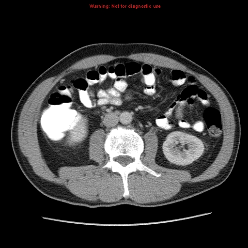 File:Appendicitis and renal cell carcinoma (Radiopaedia 17063-16760 A 29).jpg