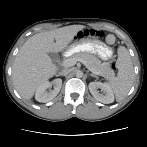 Appendicitis complicated by post-operative collection (Radiopaedia 35595-37114 A 27).jpg