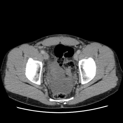 File:Appendicitis complicated by post-operative collection (Radiopaedia 35595-37114 A 78).jpg