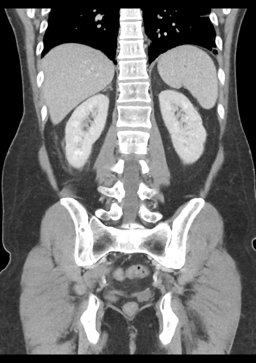 Appendicitis with thickening of the terminal ileum (Radiopaedia 42432-45550 B 42).png