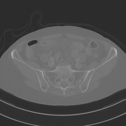 April fools' 2019- calcified peritoneal arachnoidosis (Radiopaedia 67273-76636 Axial bone window 36).png
