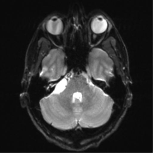 File:Arachnoid cyst - cerebellopontine angle (Radiopaedia 59689-67083 Axial DWI 10).png