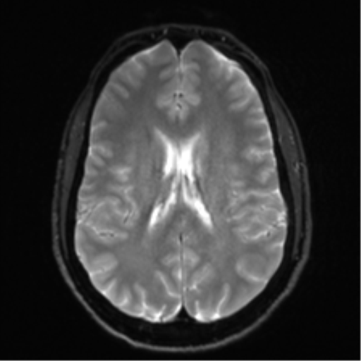 Arachnoid cyst - cerebellopontine angle (Radiopaedia 59689-67083 Axial DWI 22).png