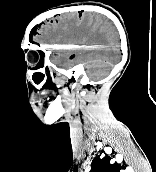 Arrow injury to the brain (Radiopaedia 72101-82607 H 44).jpg