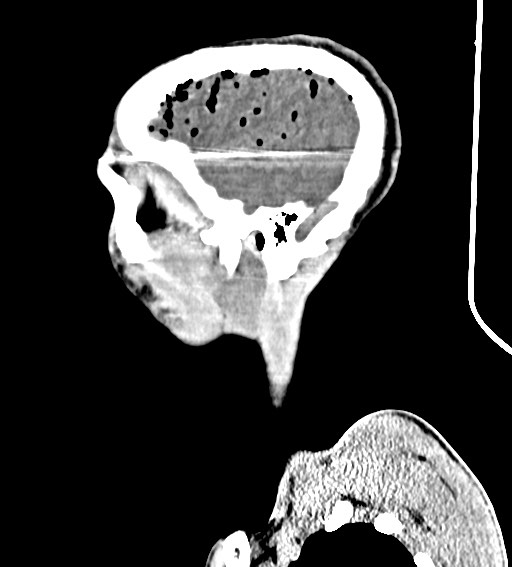 Arrow injury to the brain (Radiopaedia 72101-82607 H 51).jpg